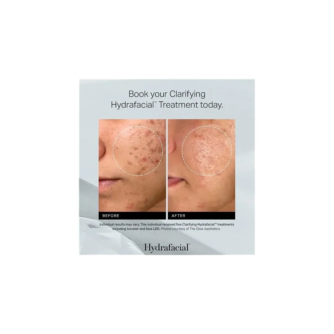 Hydrafacial treatment before and after comparison.