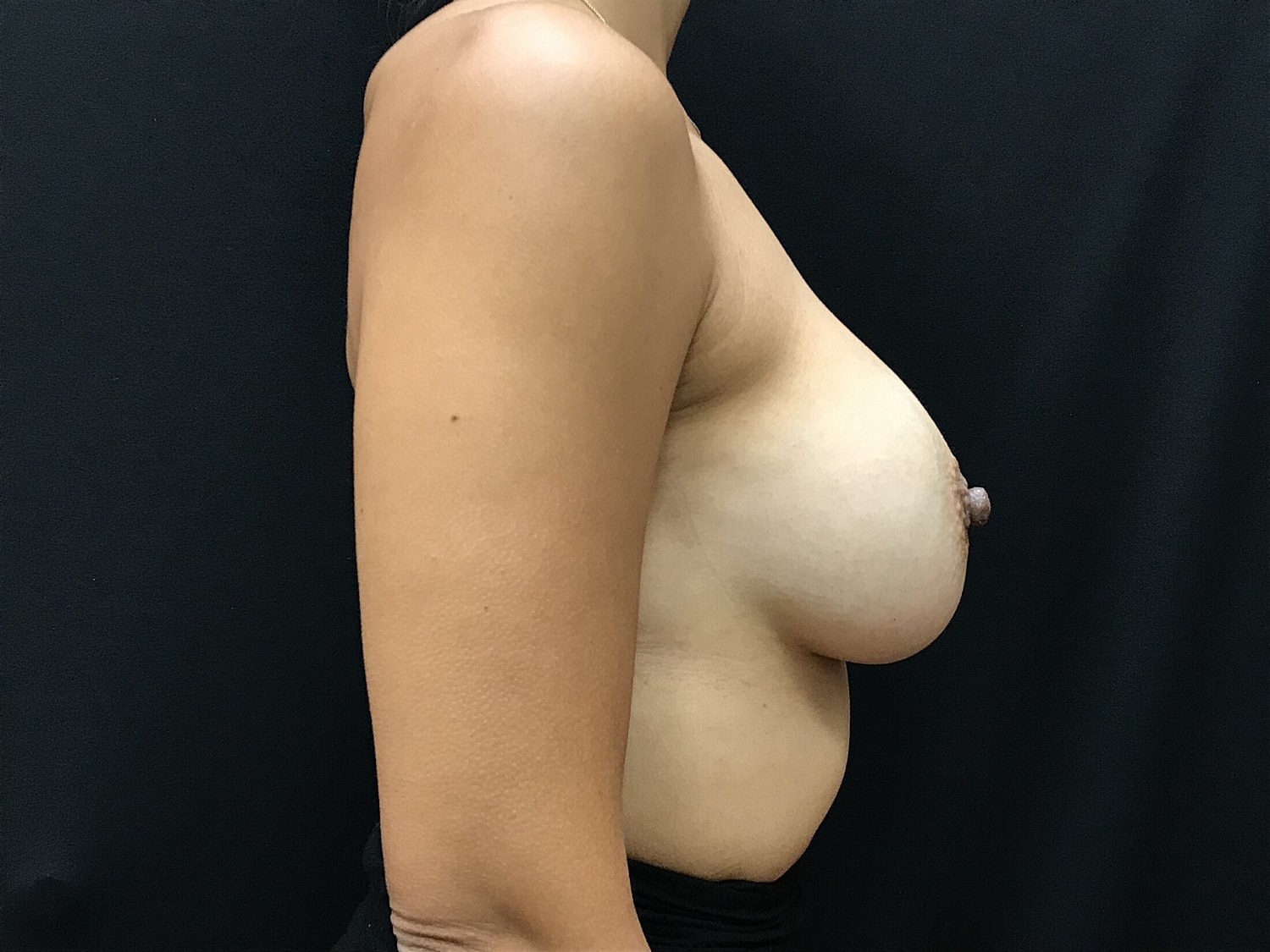 Breast Augmentation Before & After
