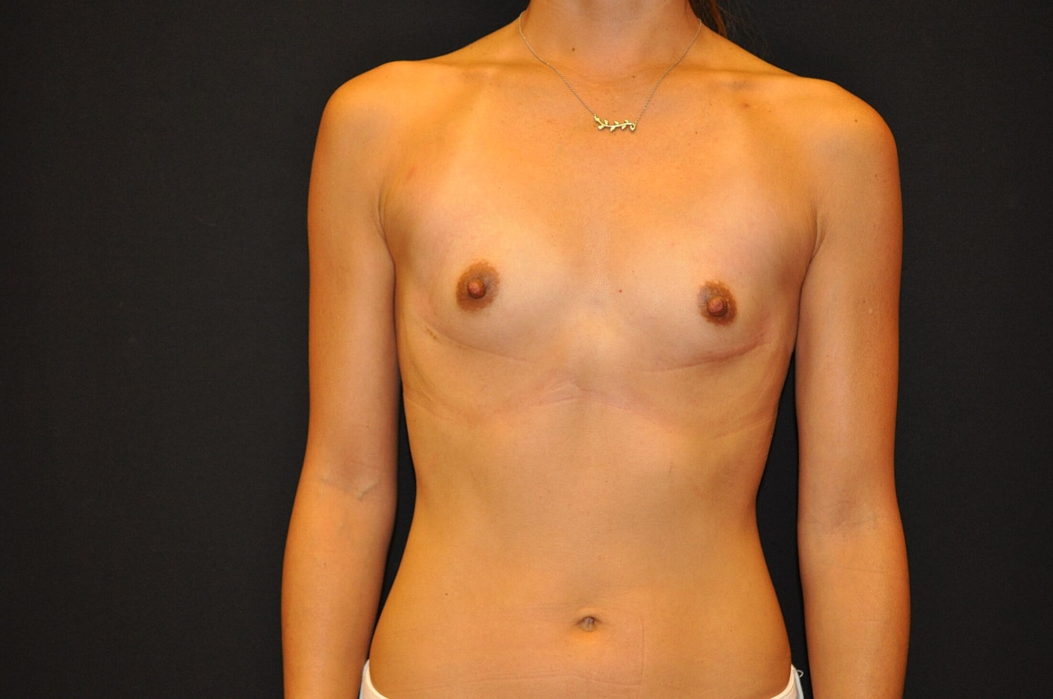 Breast Augmentation Before & After