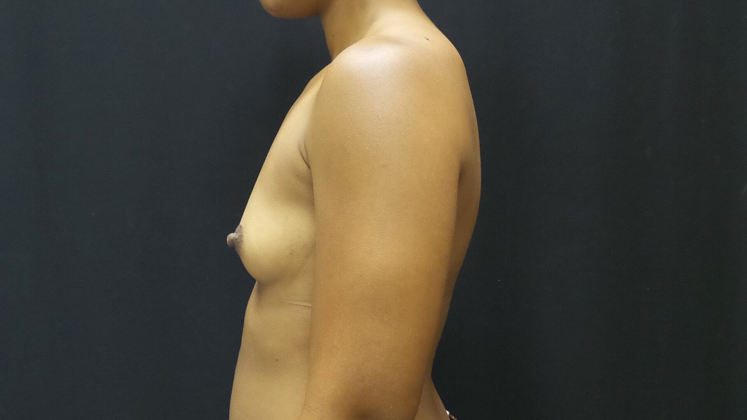 Breast Augmentation Before & After
