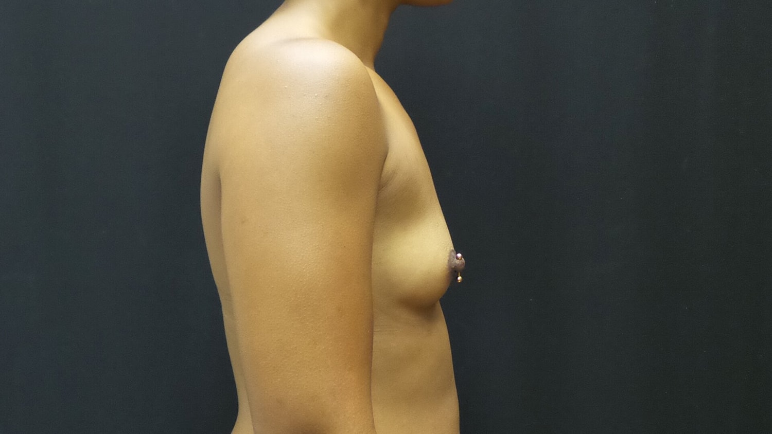 Breast Augmentation Before & After