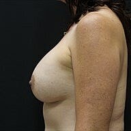 Breast Augmentation Before & After