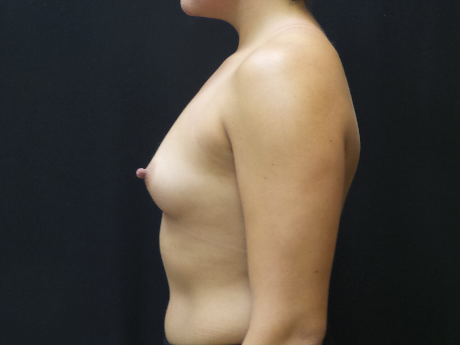 Breast Augmentation Before & After