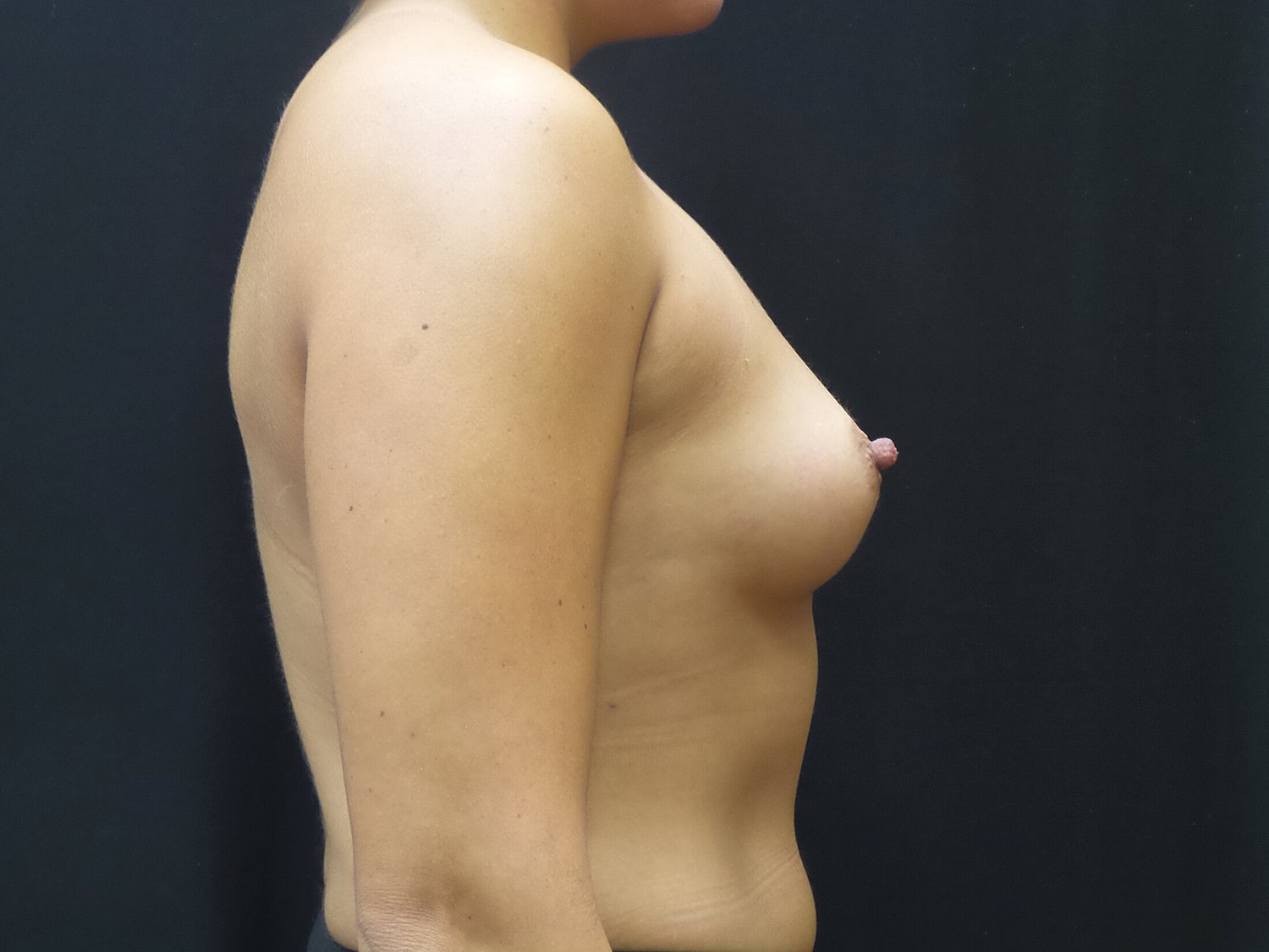 Breast Augmentation Before & After
