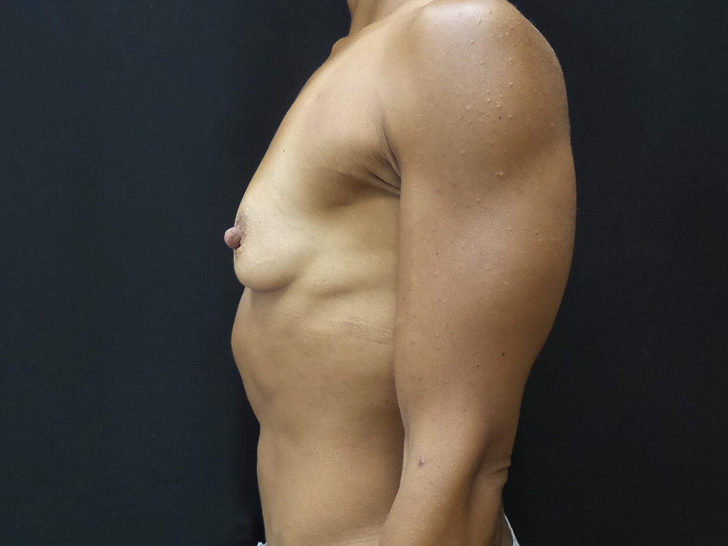 Breast Augmentation Before & After