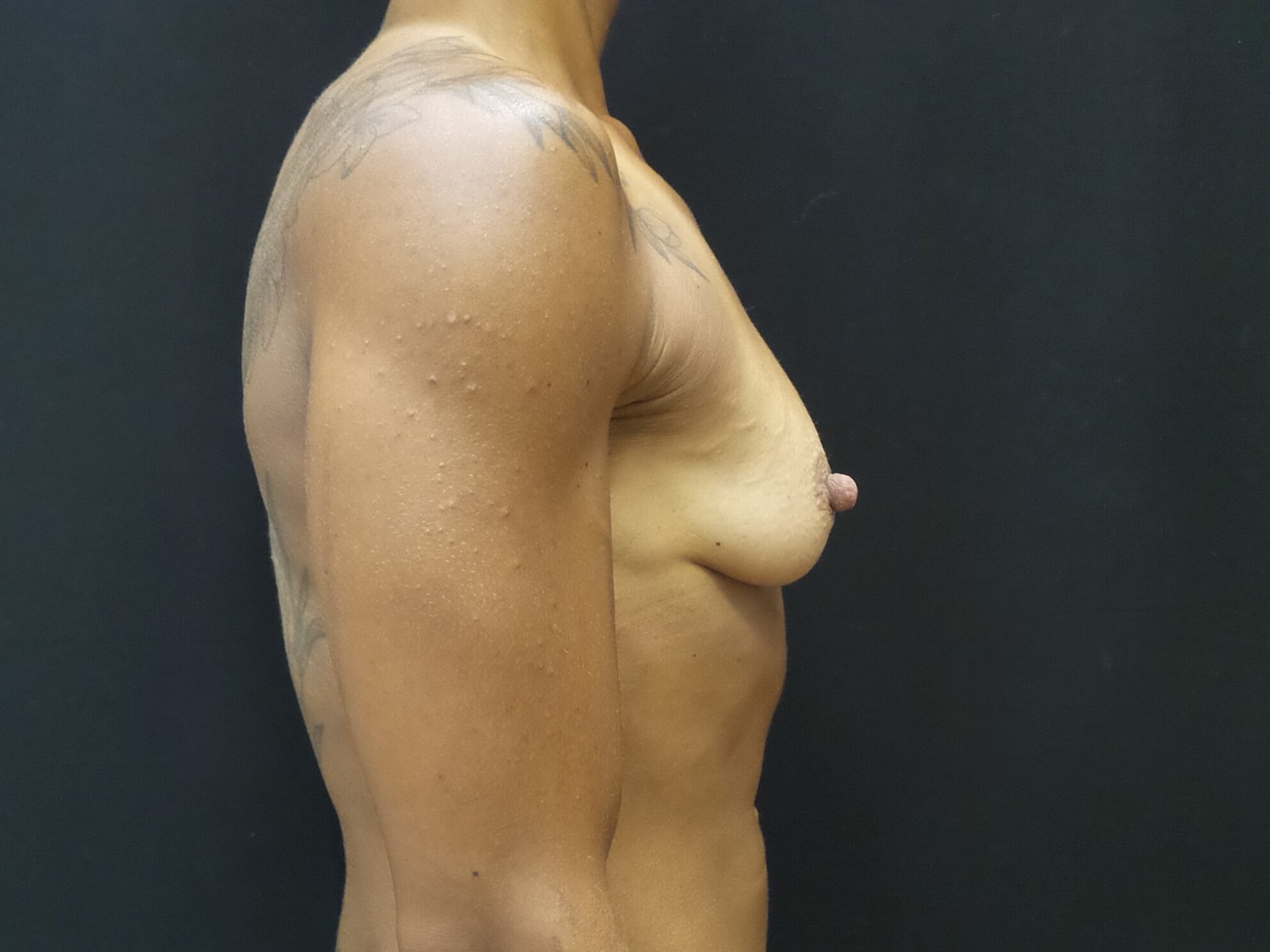 Breast Augmentation Before & After