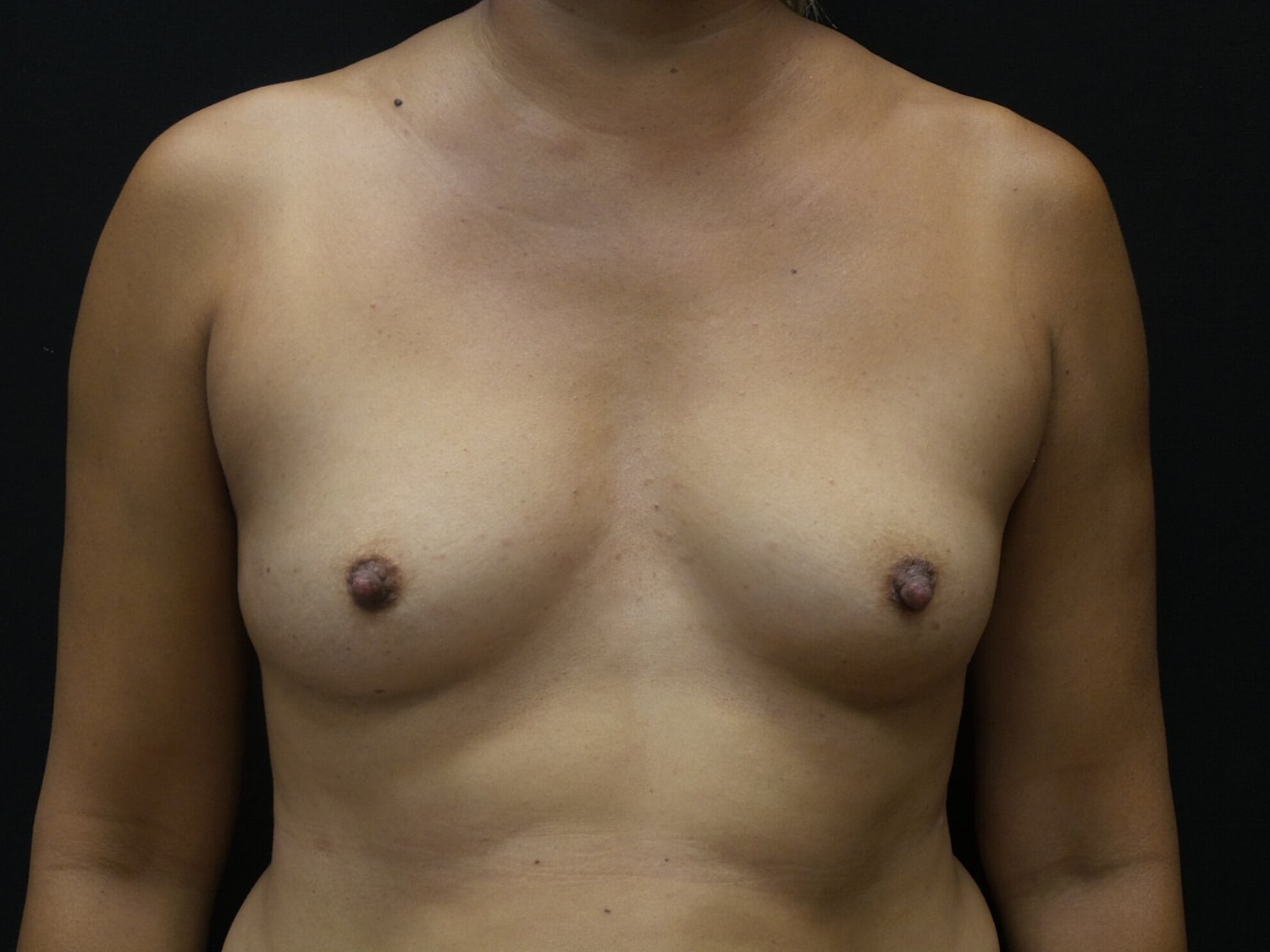 Breast Augmentation Before & After