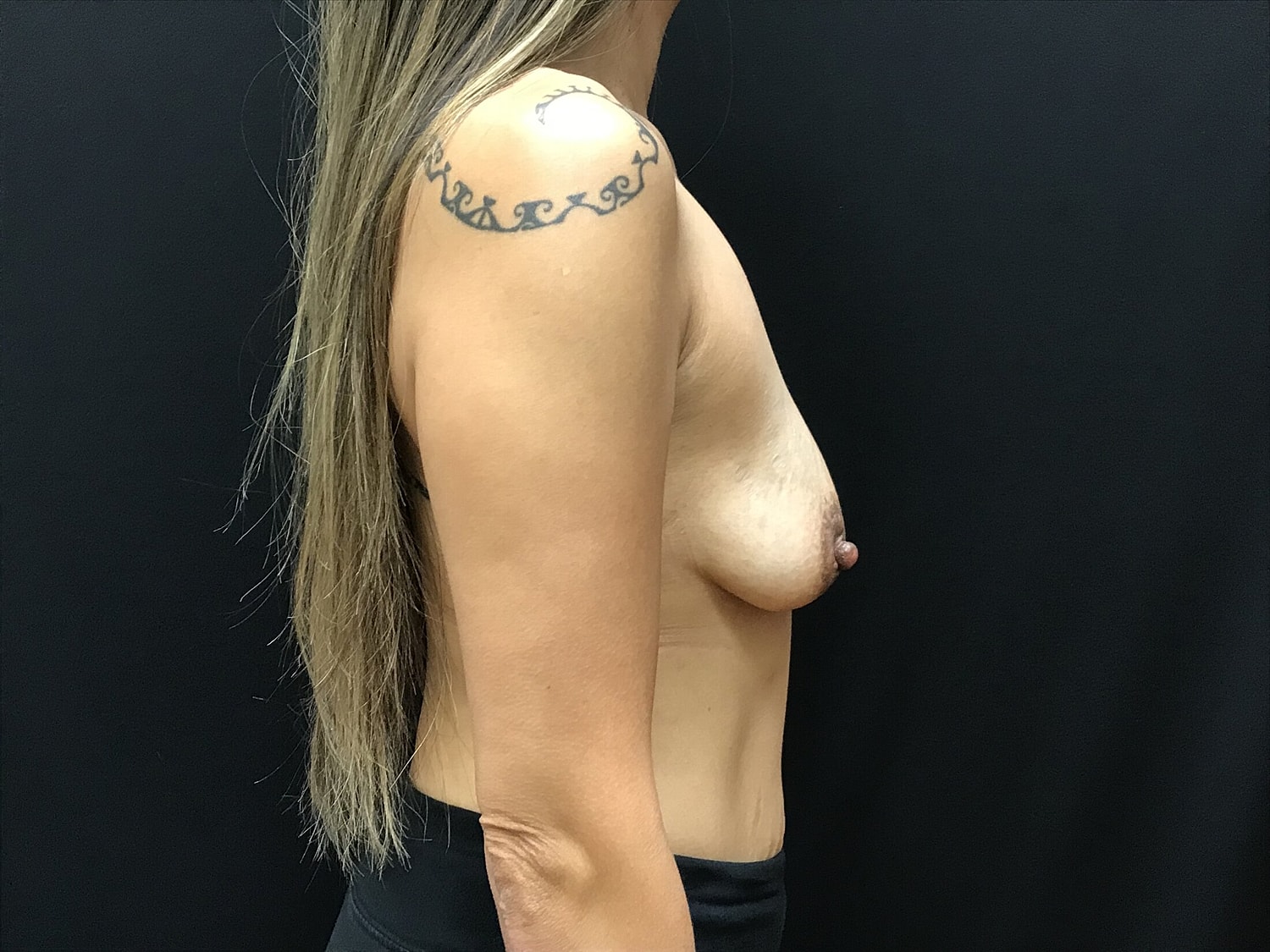 Breast Augmentation Before & After