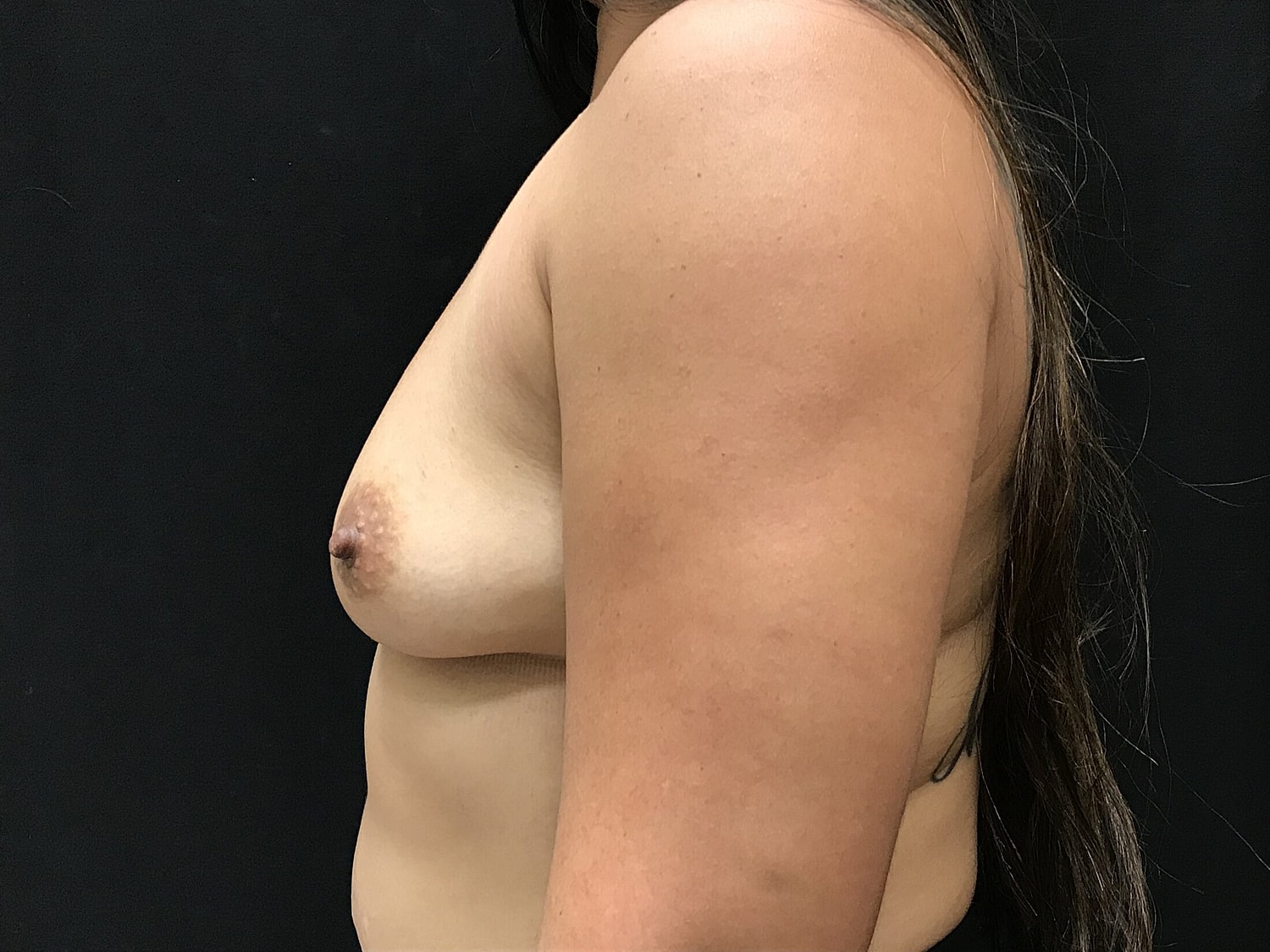Breast Augmentation Before & After