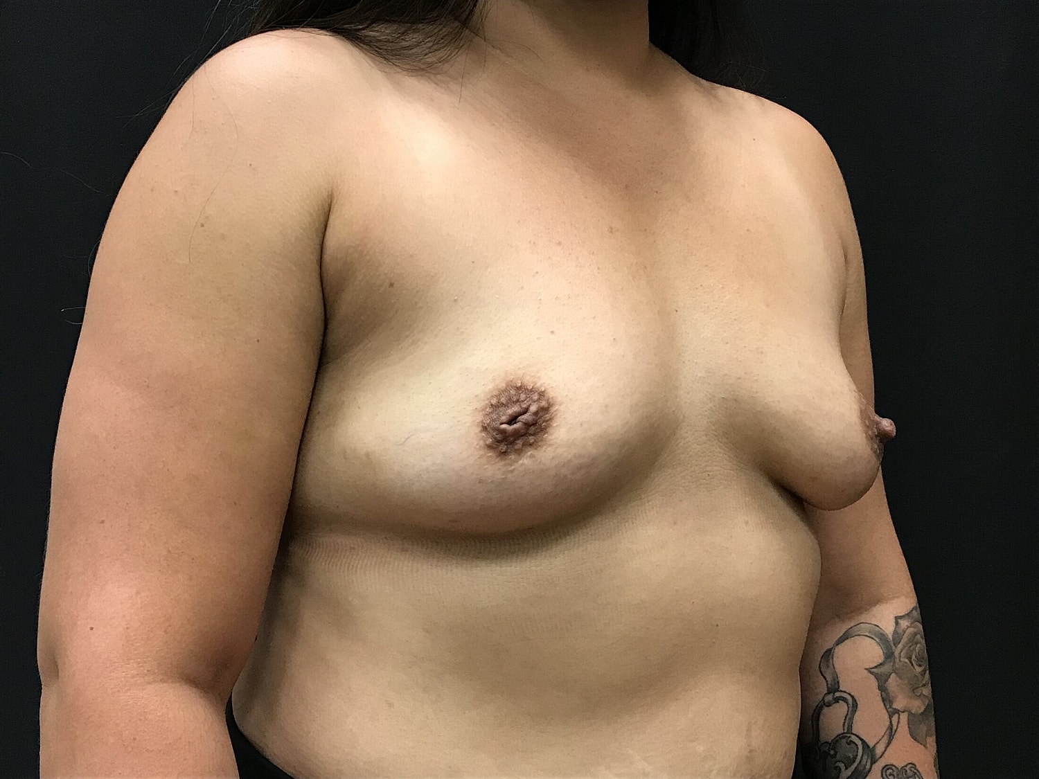 Breast Augmentation Before & After