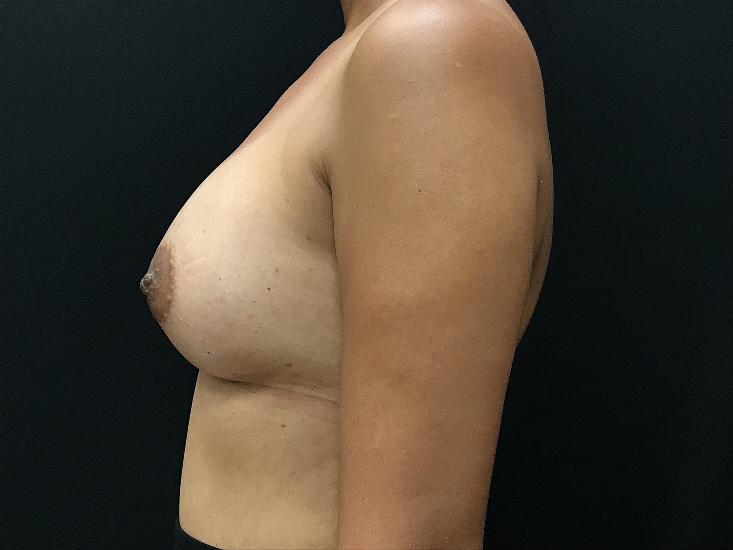 Breast Augmentation Before & After