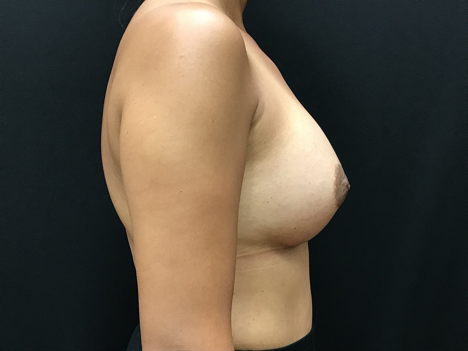 Breast Augmentation Before & After