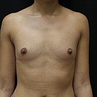 Breast Augmentation Before & After