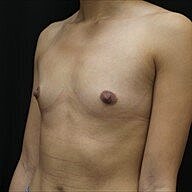 Breast Augmentation Before & After
