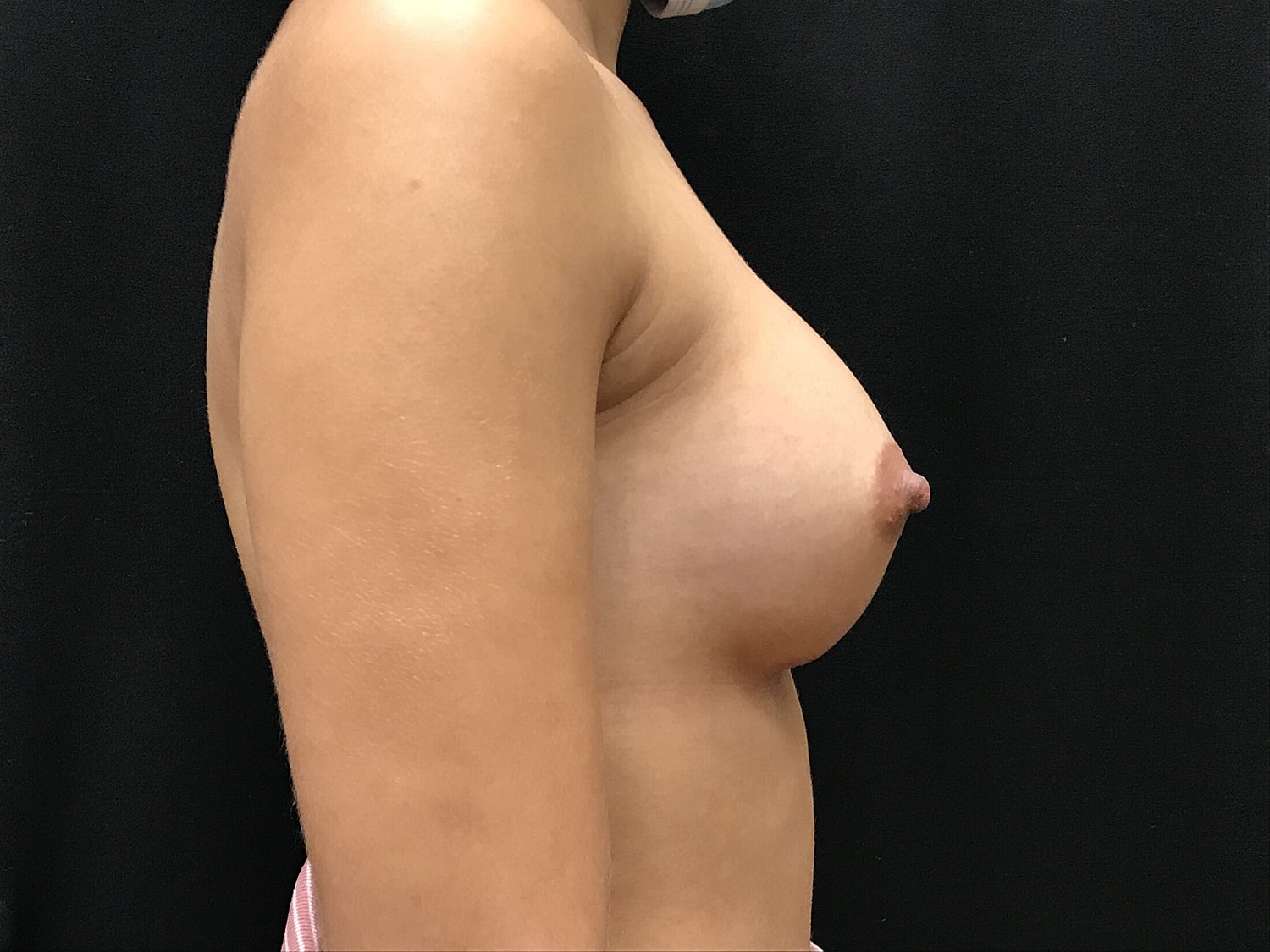 Breast Augmentation Before & After