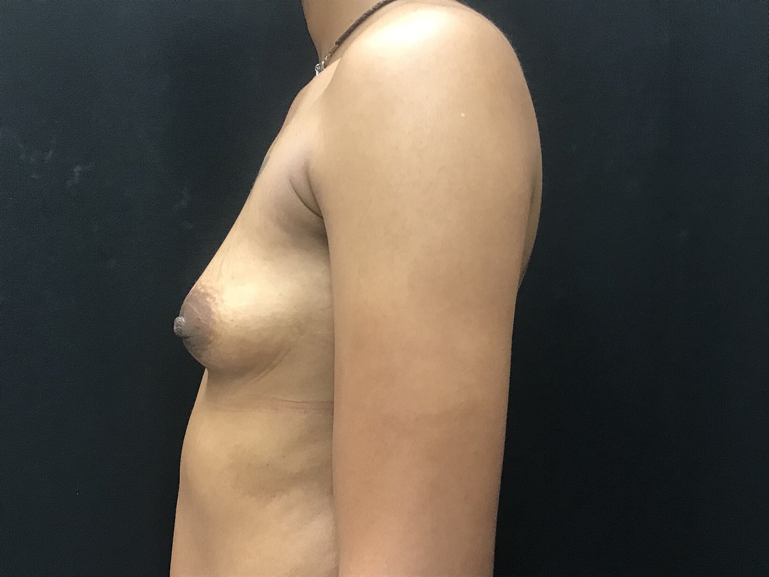 Breast Augmentation Before & After