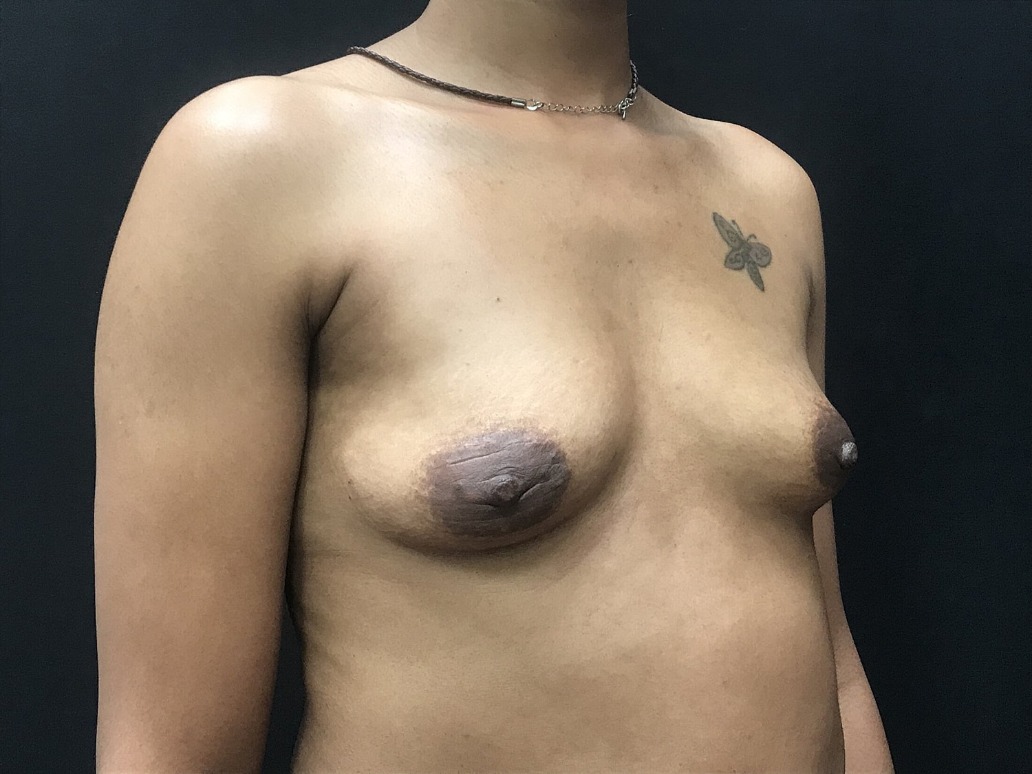 Breast Augmentation Before & After