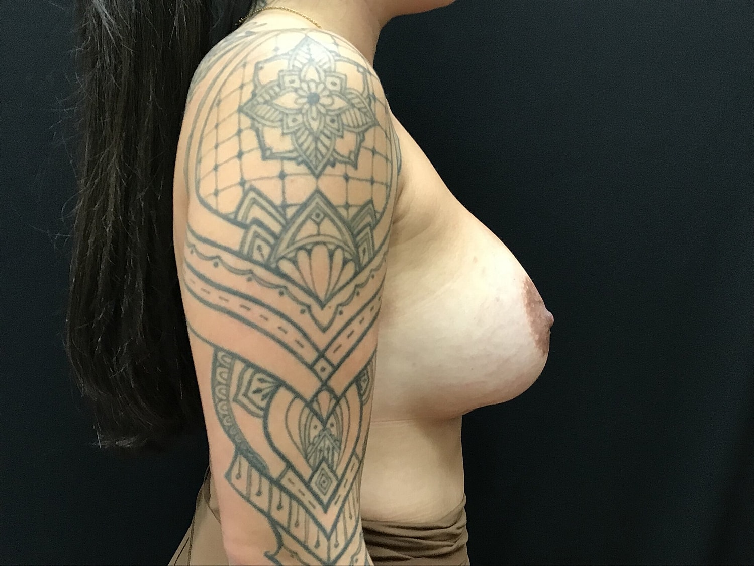 Breast Augmentation Before & After