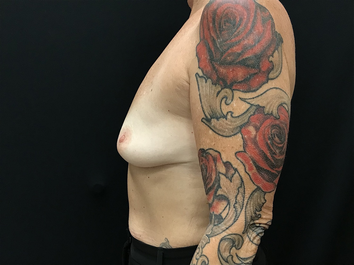 Breast Augmentation Before & After