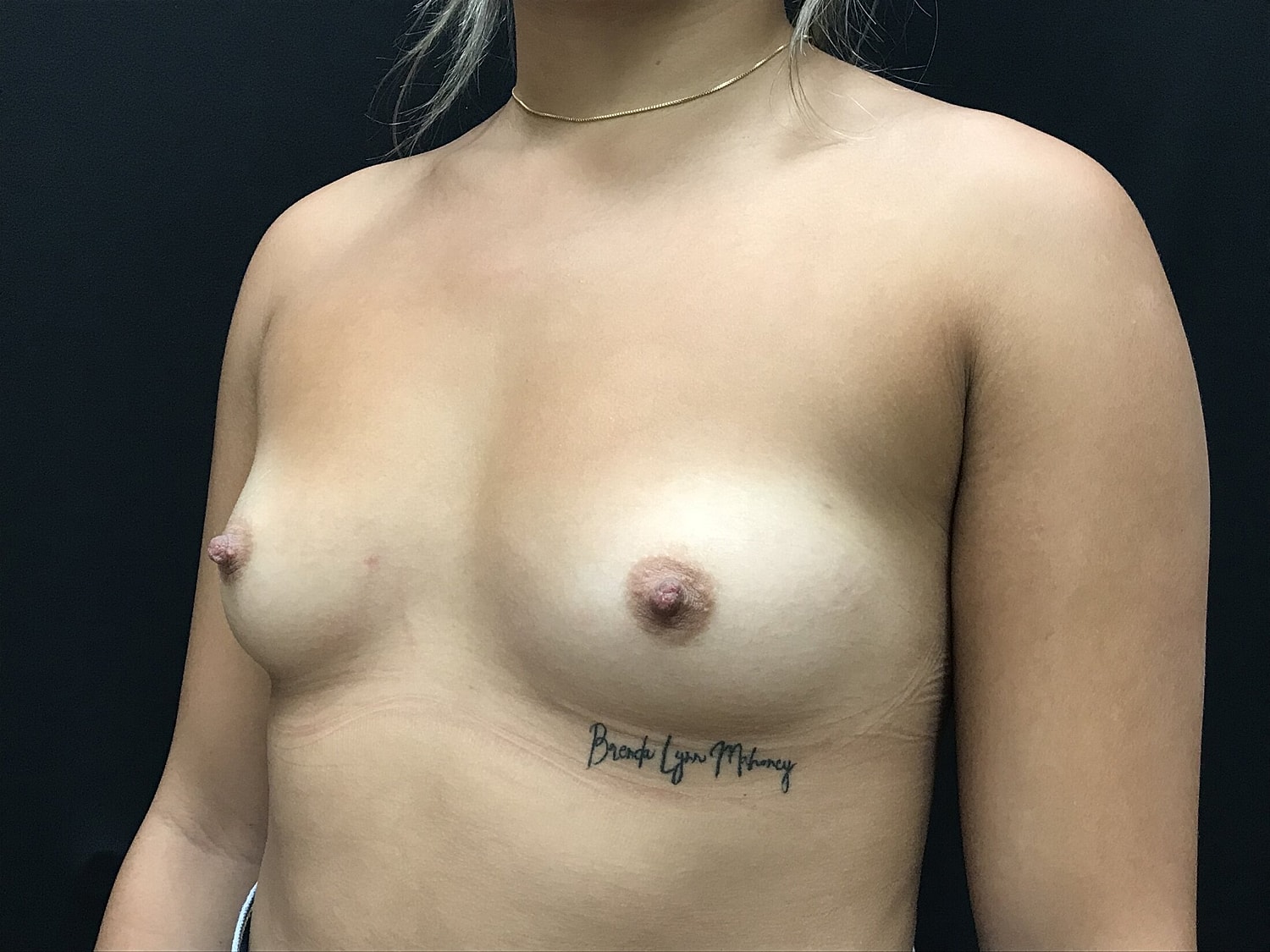 Breast Augmentation Before & After