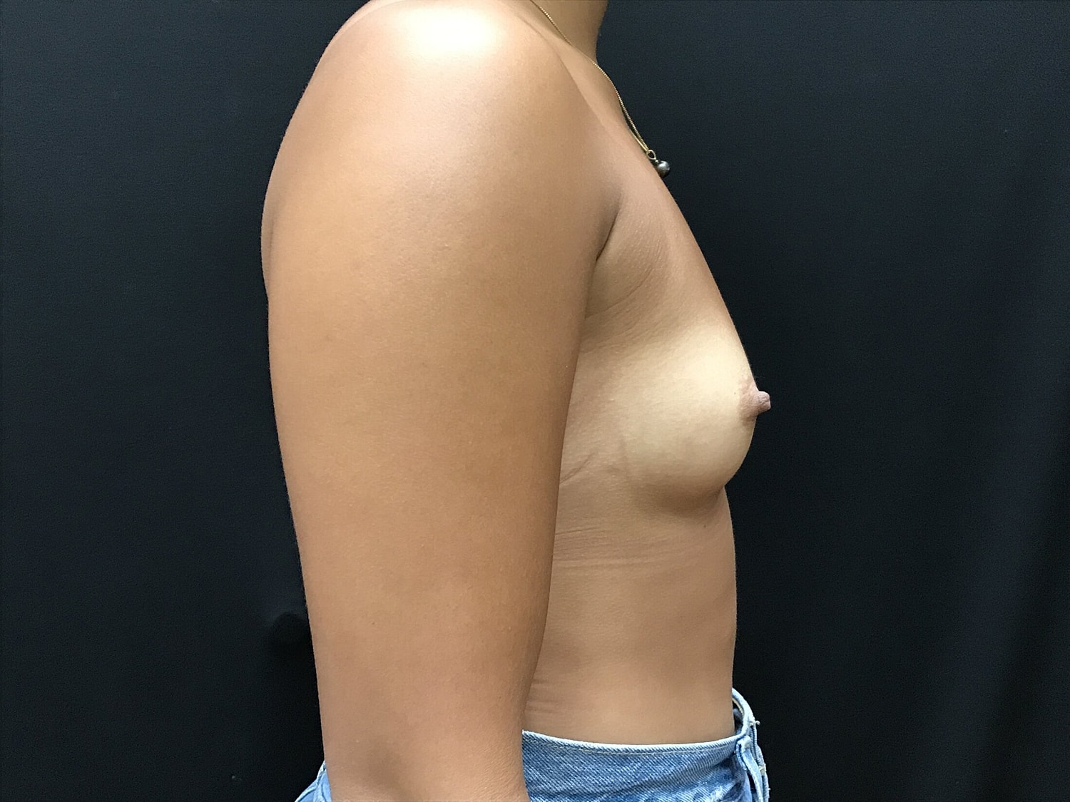 Breast Augmentation Before & After