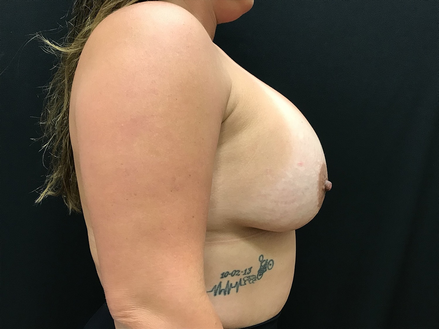 Breast Augmentation Before & After