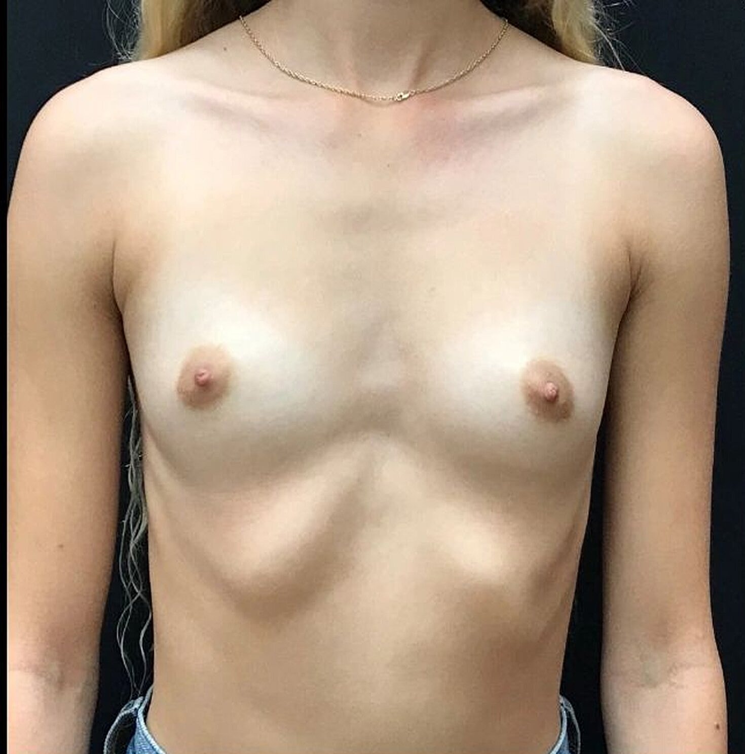 Breast Augmentation Before & After