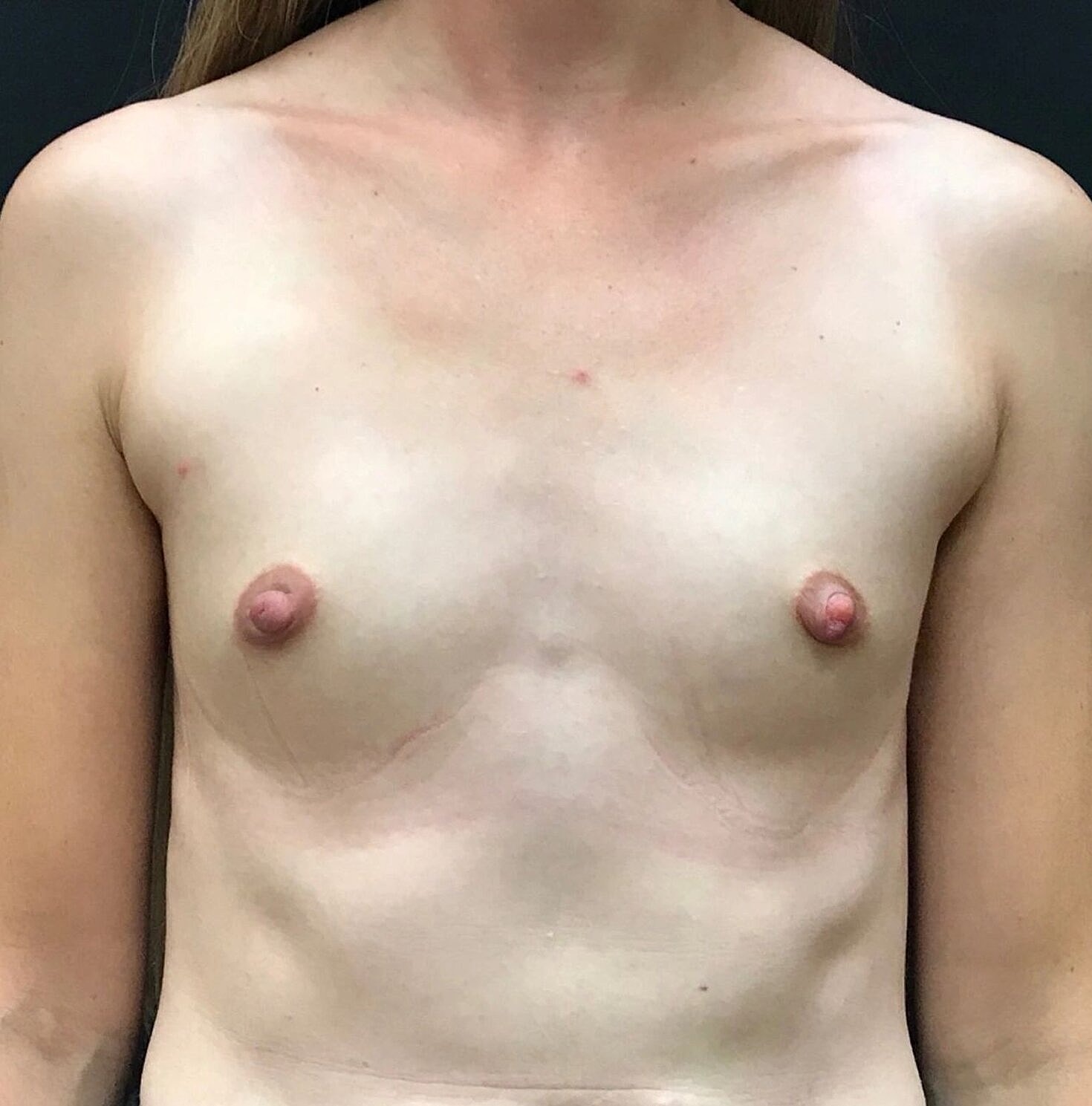 Breast Augmentation Before & After