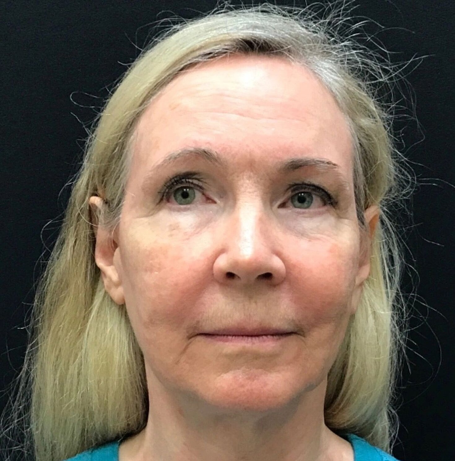 Facelift Before & After