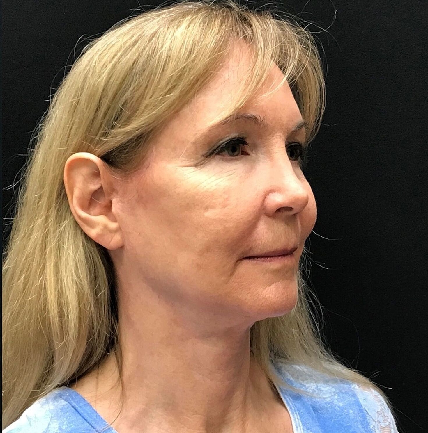 Facelift Before & After