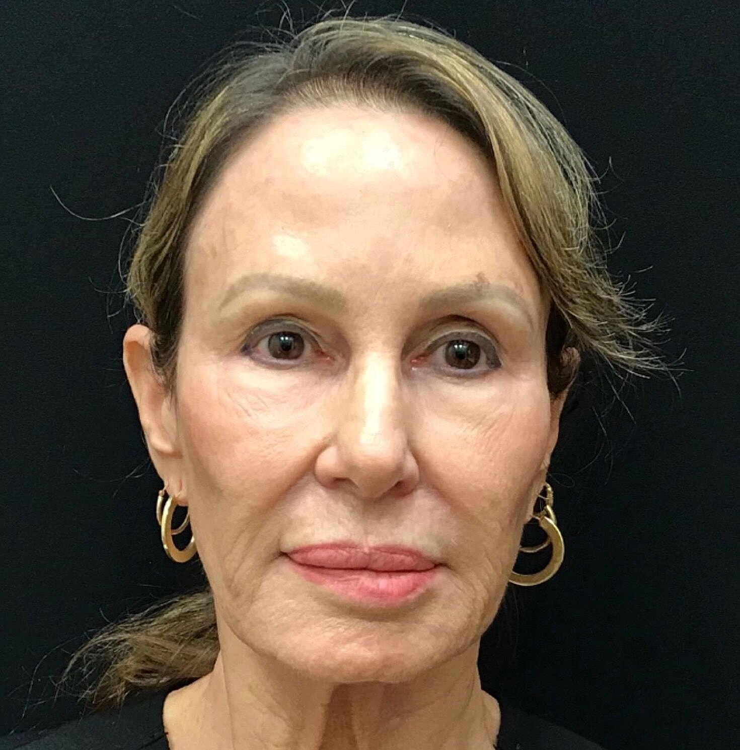 Facelift Before & After