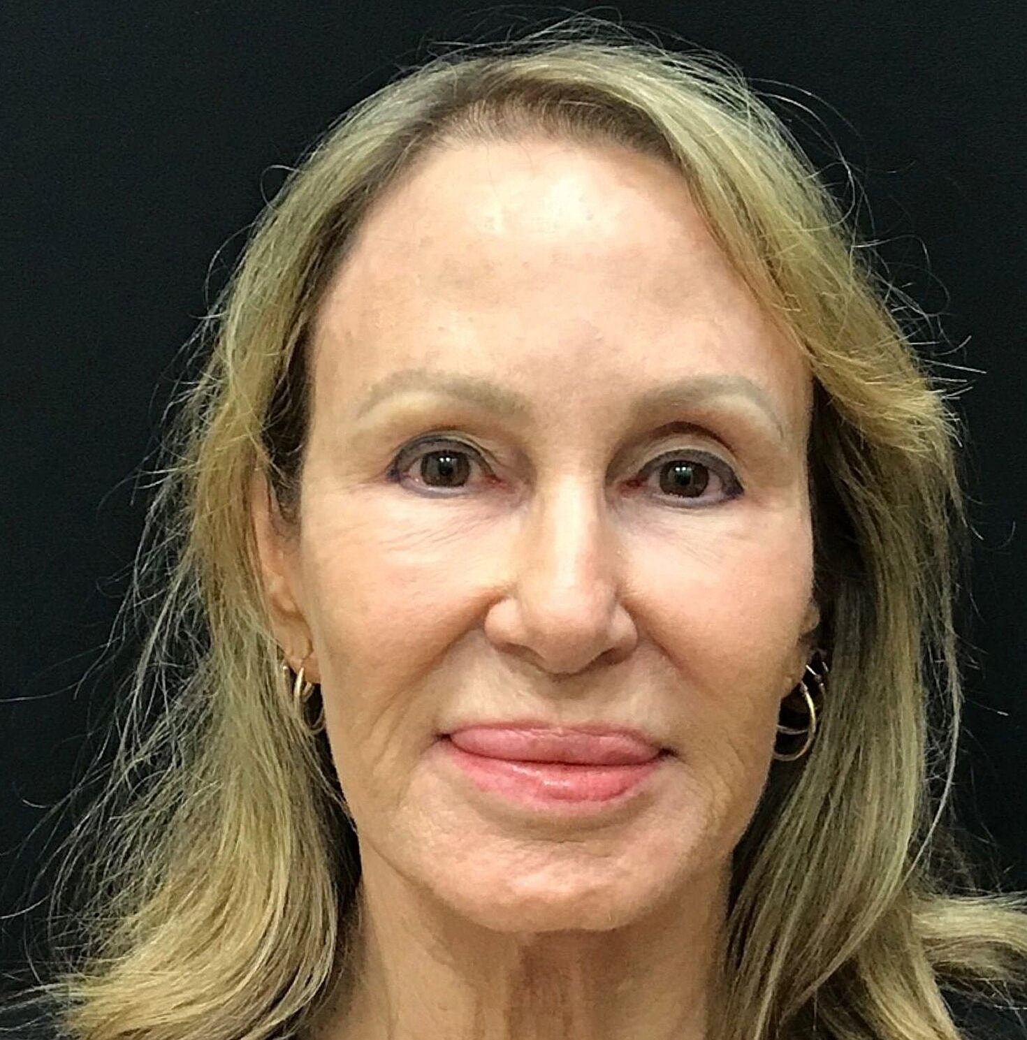 Facelift Before & After