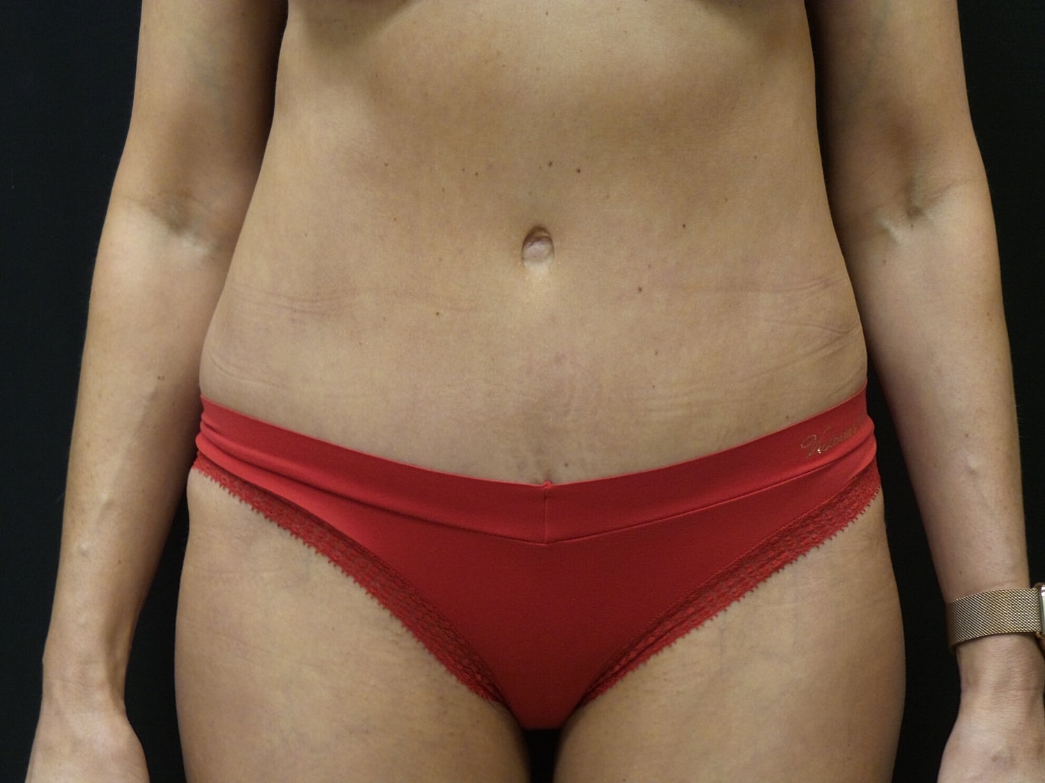 Tummy Tuck Before & After