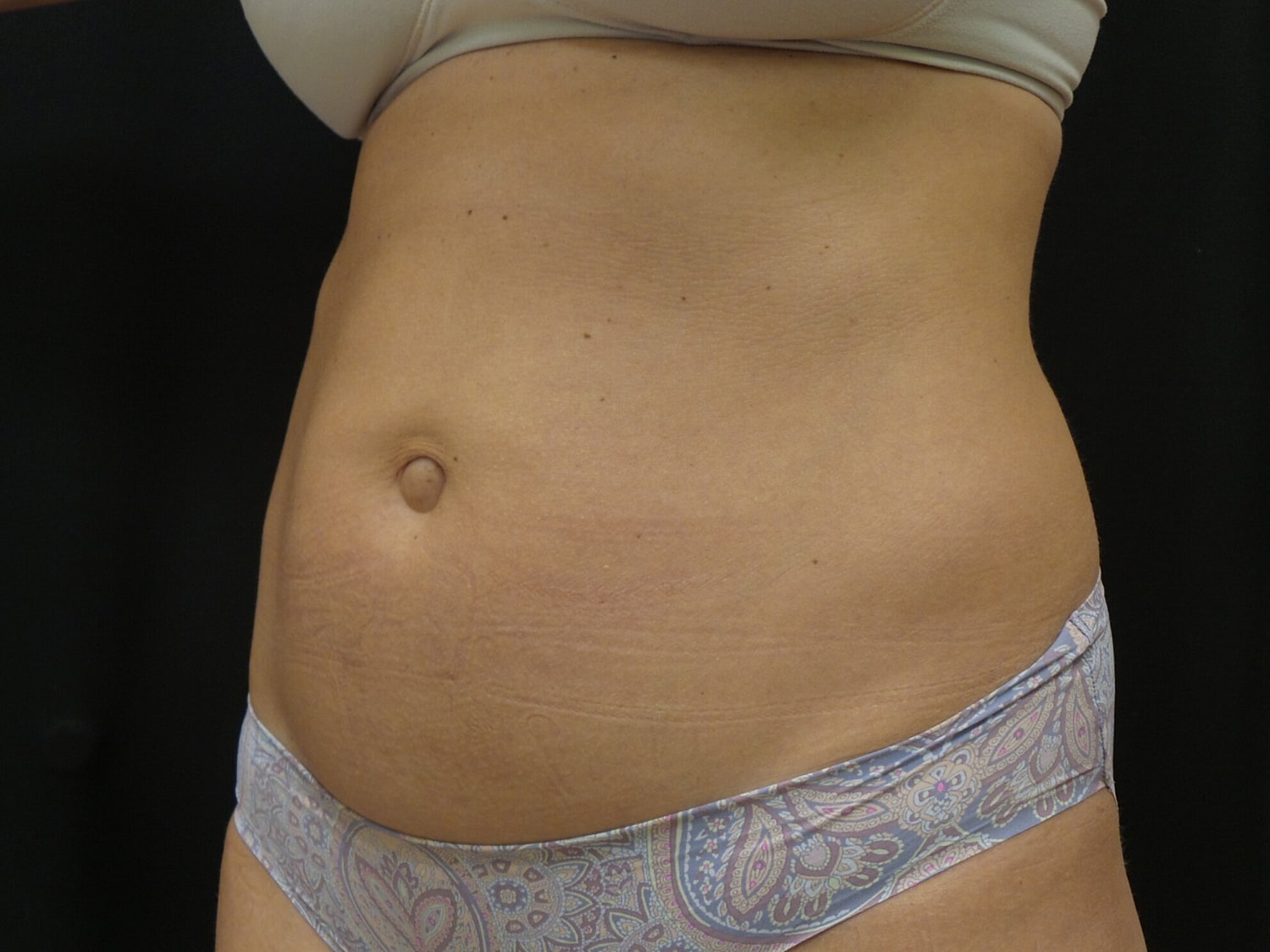 Tummy Tuck Before & After