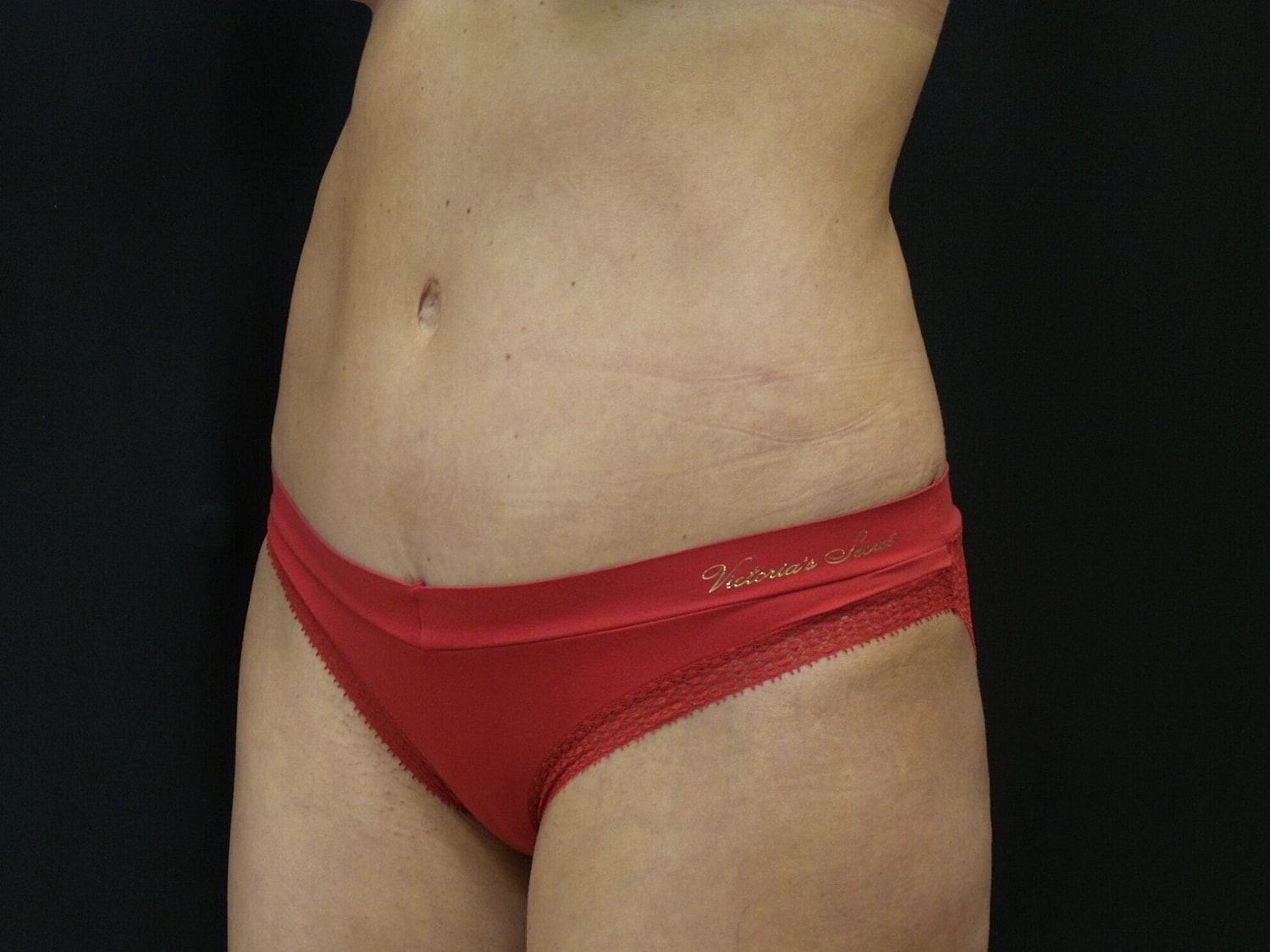 Tummy Tuck Before & After
