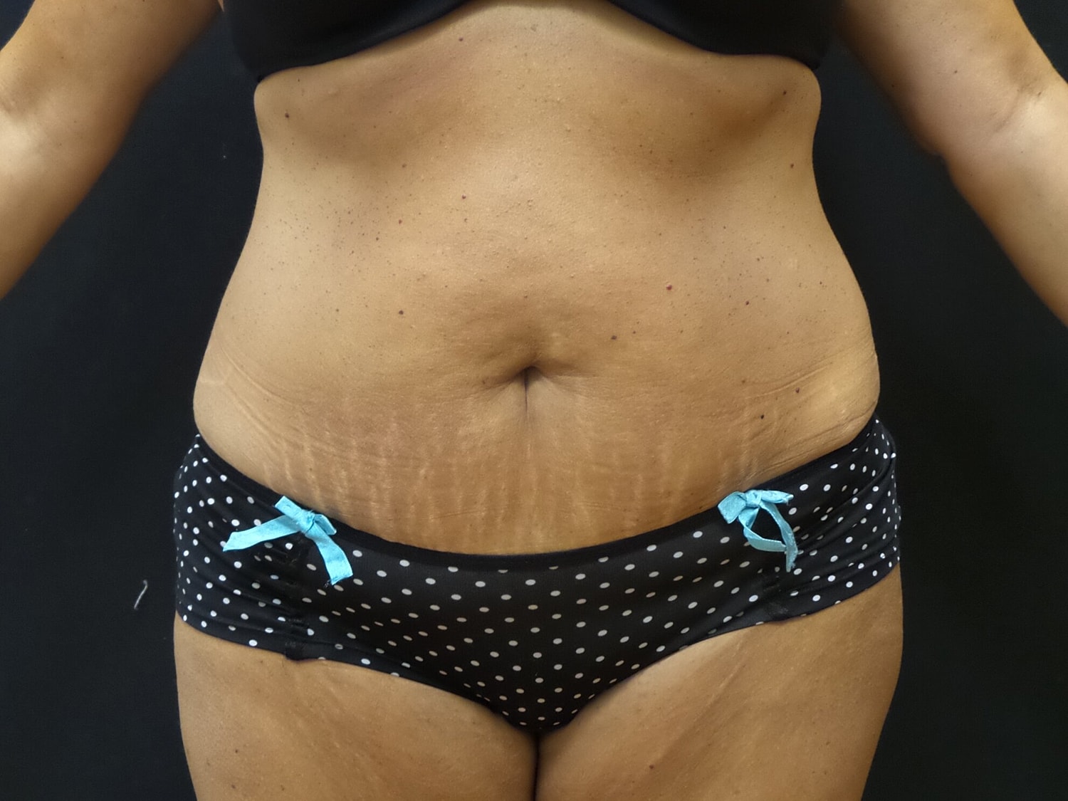 Tummy Tuck Before & After