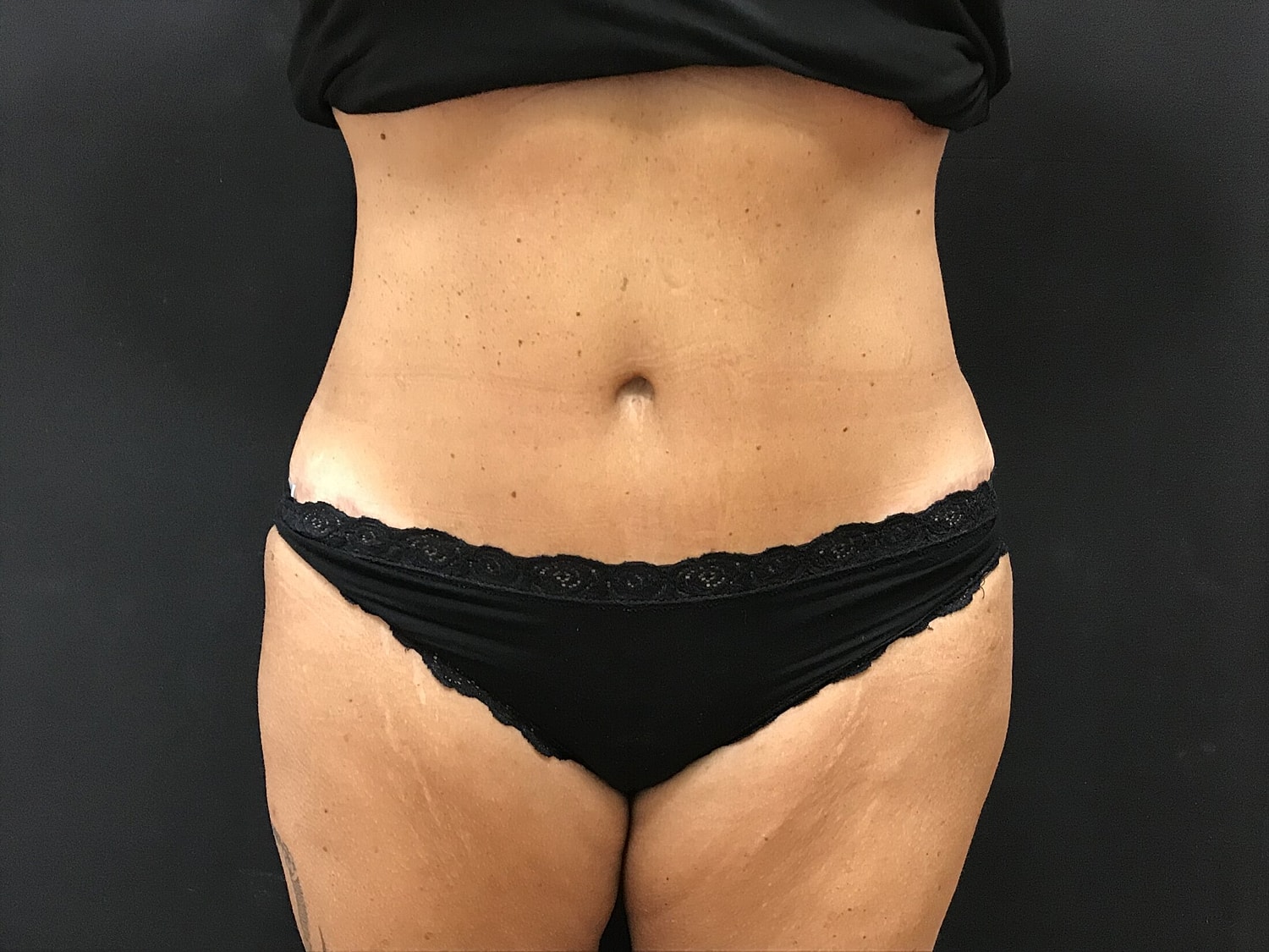 Tummy Tuck Before & After