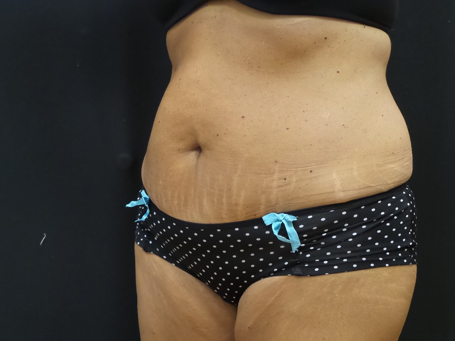 Tummy Tuck Before & After