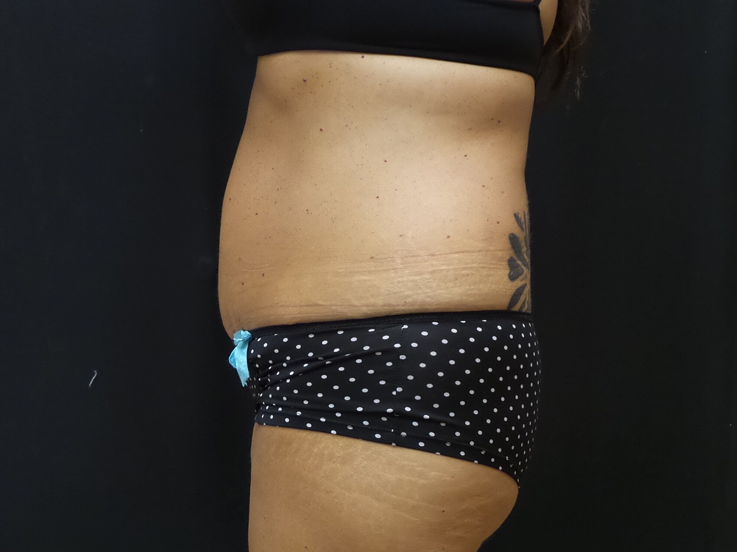 Tummy Tuck Before & After