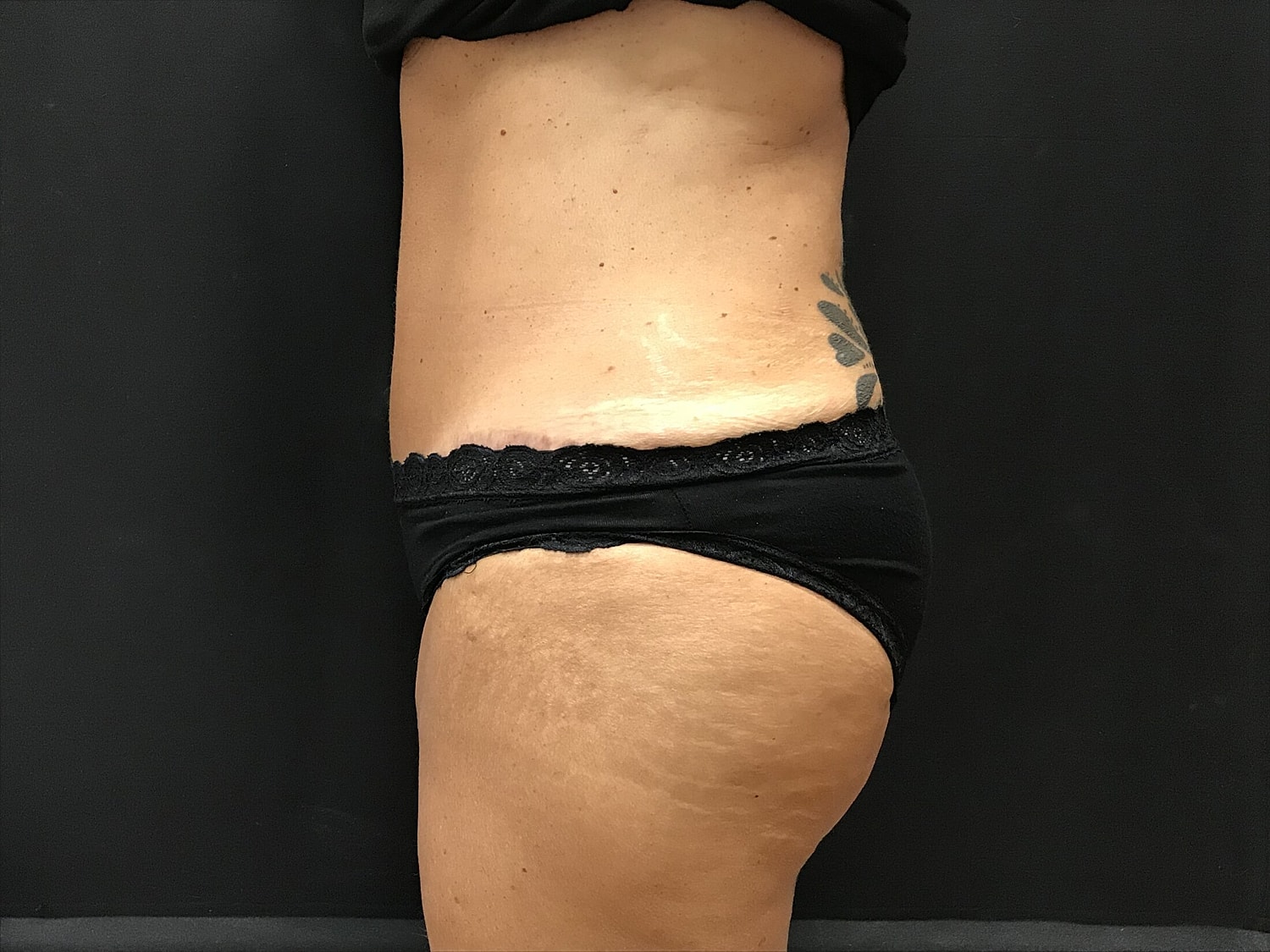 Tummy Tuck Before & After