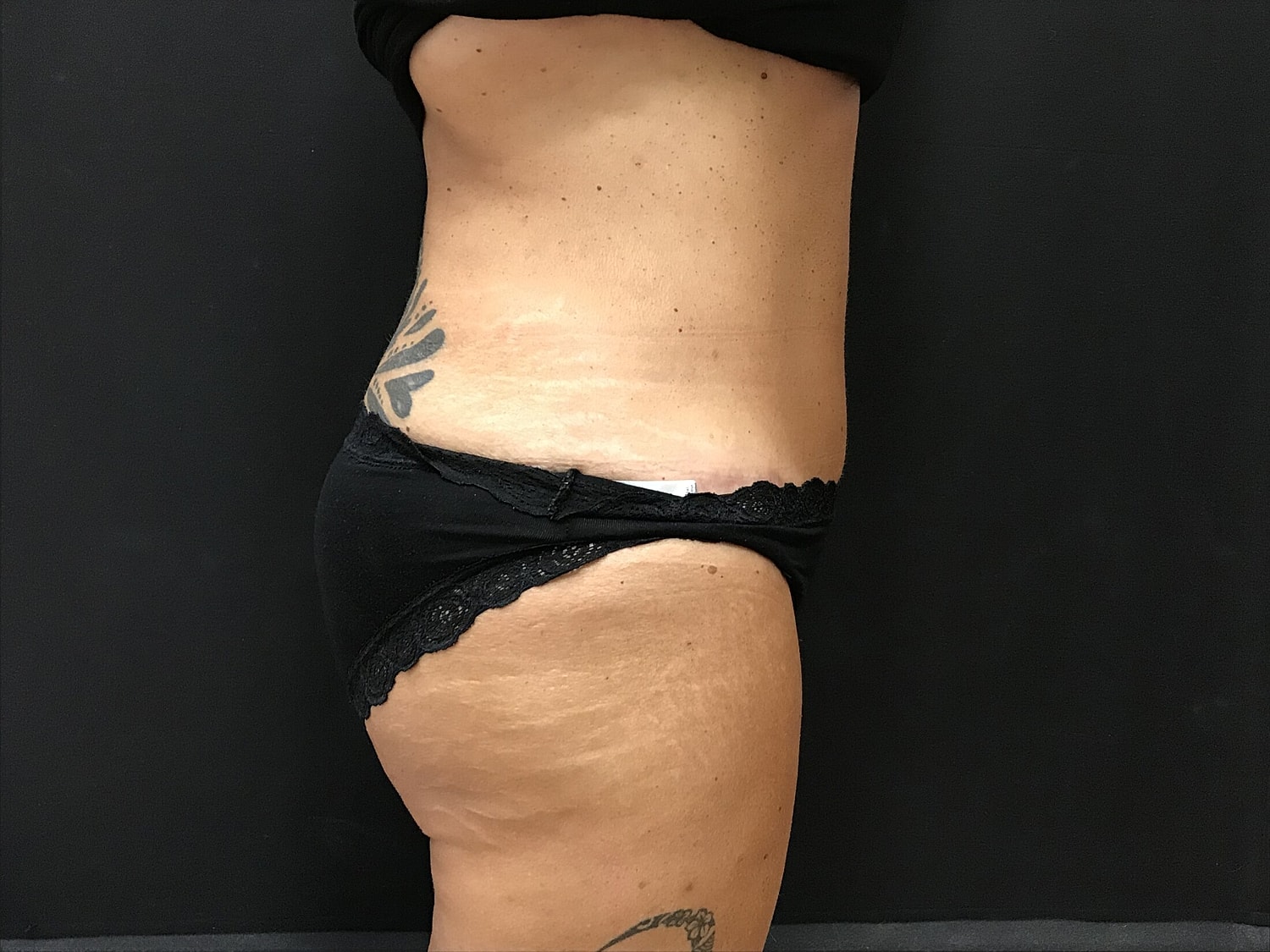 Tummy Tuck Before & After