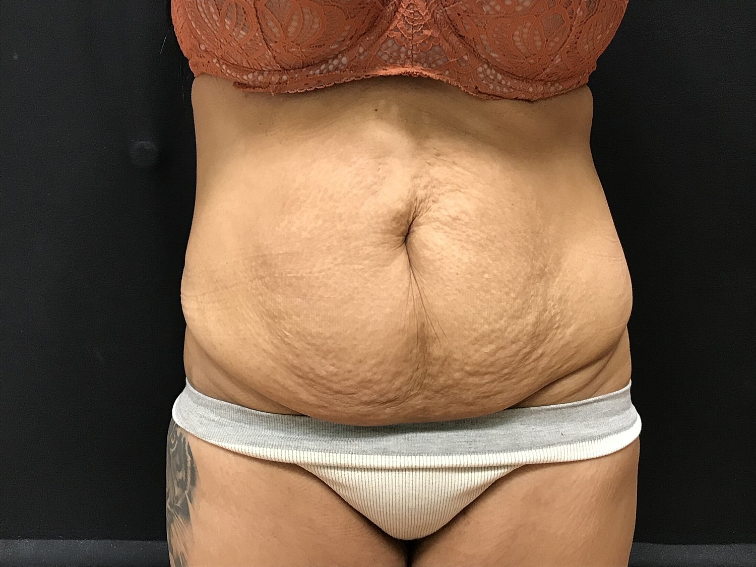 Tummy Tuck Before & After