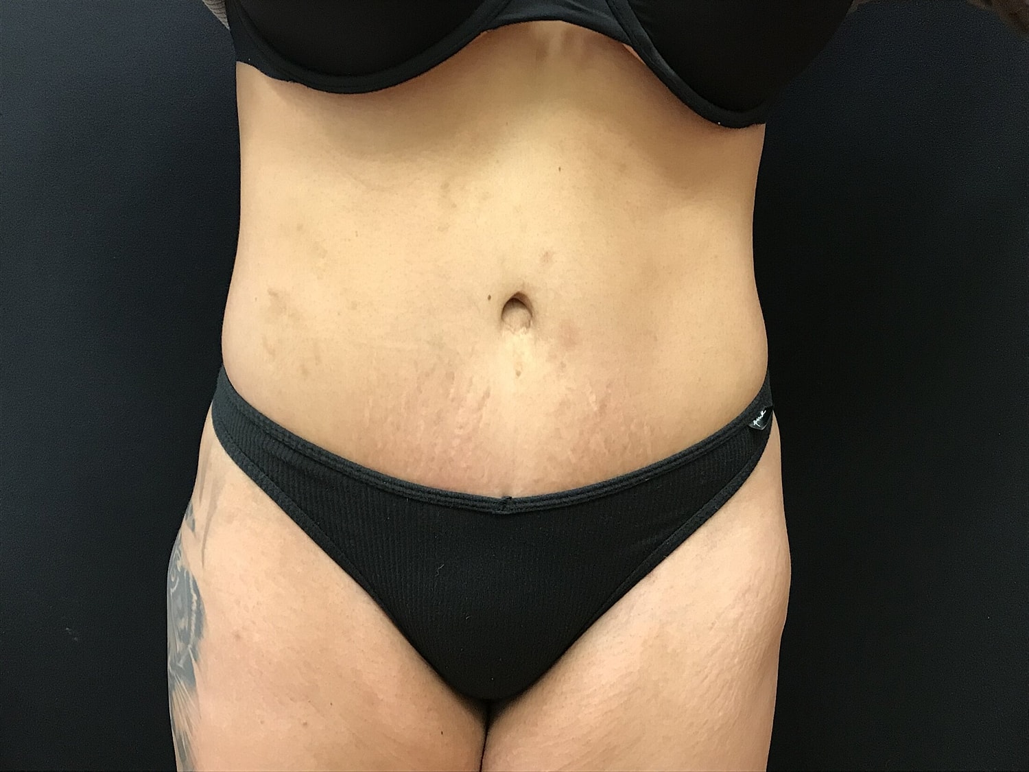 Tummy Tuck Before & After