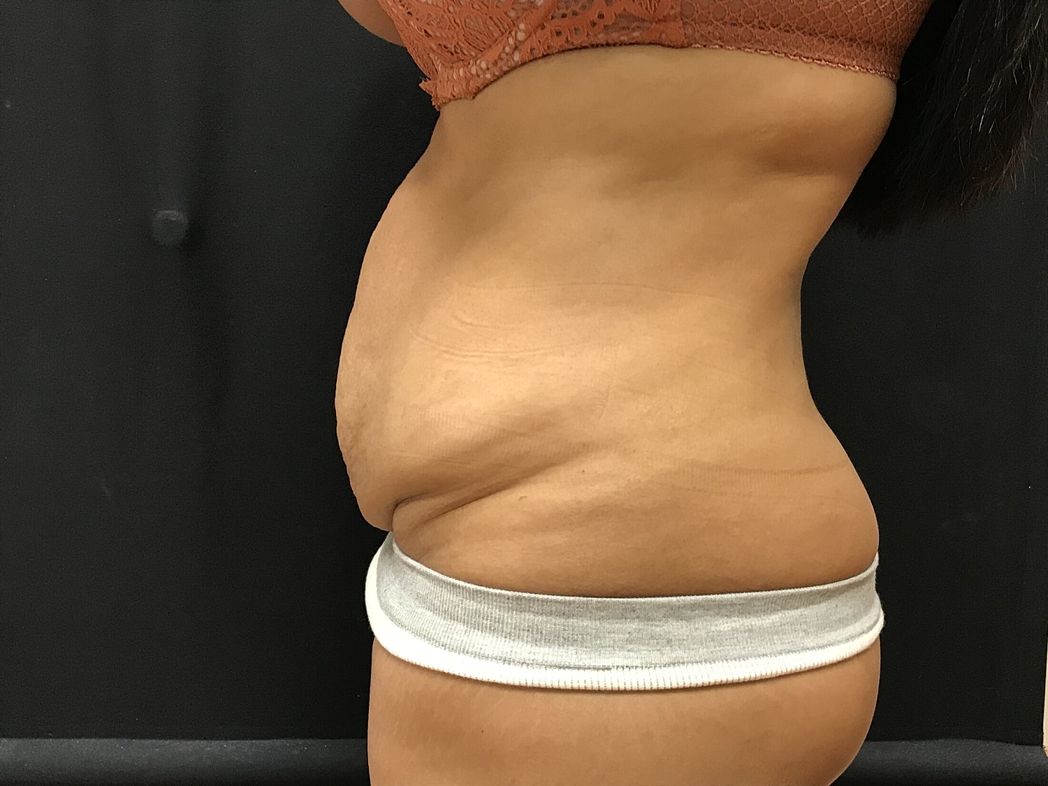 Tummy Tuck Before & After