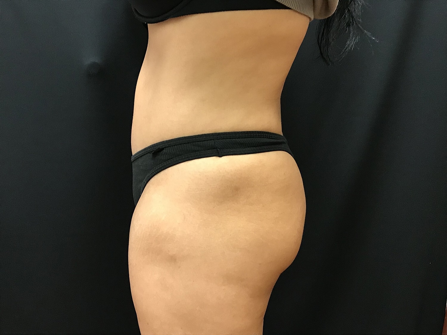 Tummy Tuck Before & After