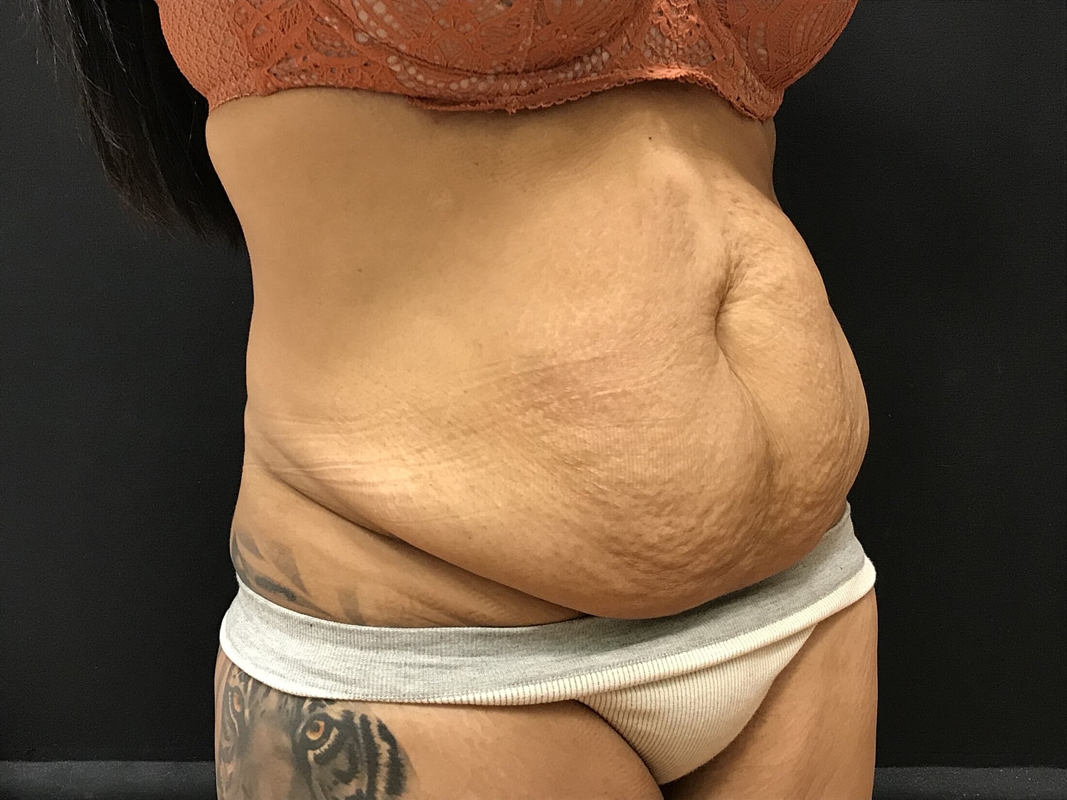 Tummy Tuck Before & After