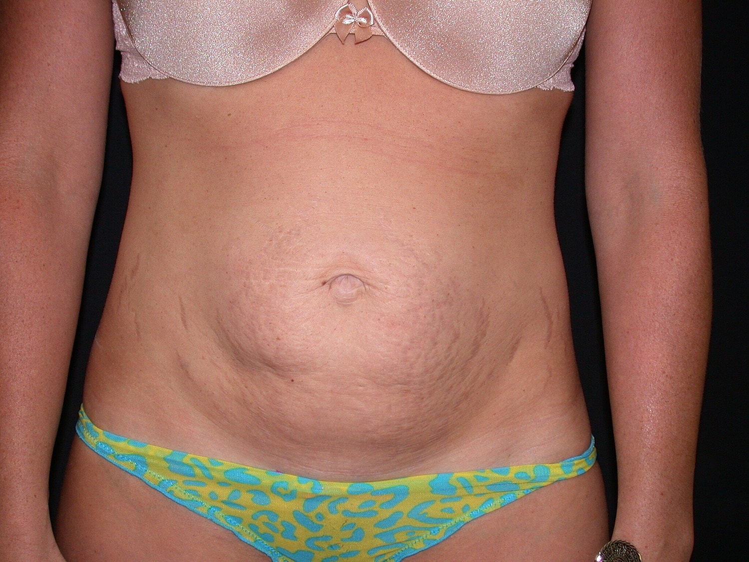 Tummy Tuck Before & After