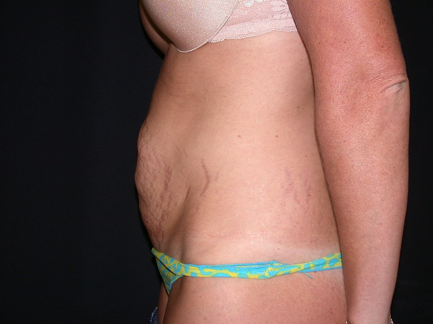 Tummy Tuck Before & After