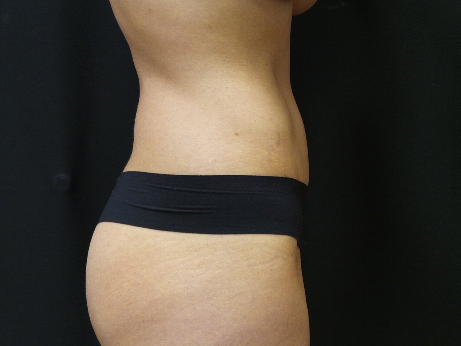 Tummy Tuck Before & After