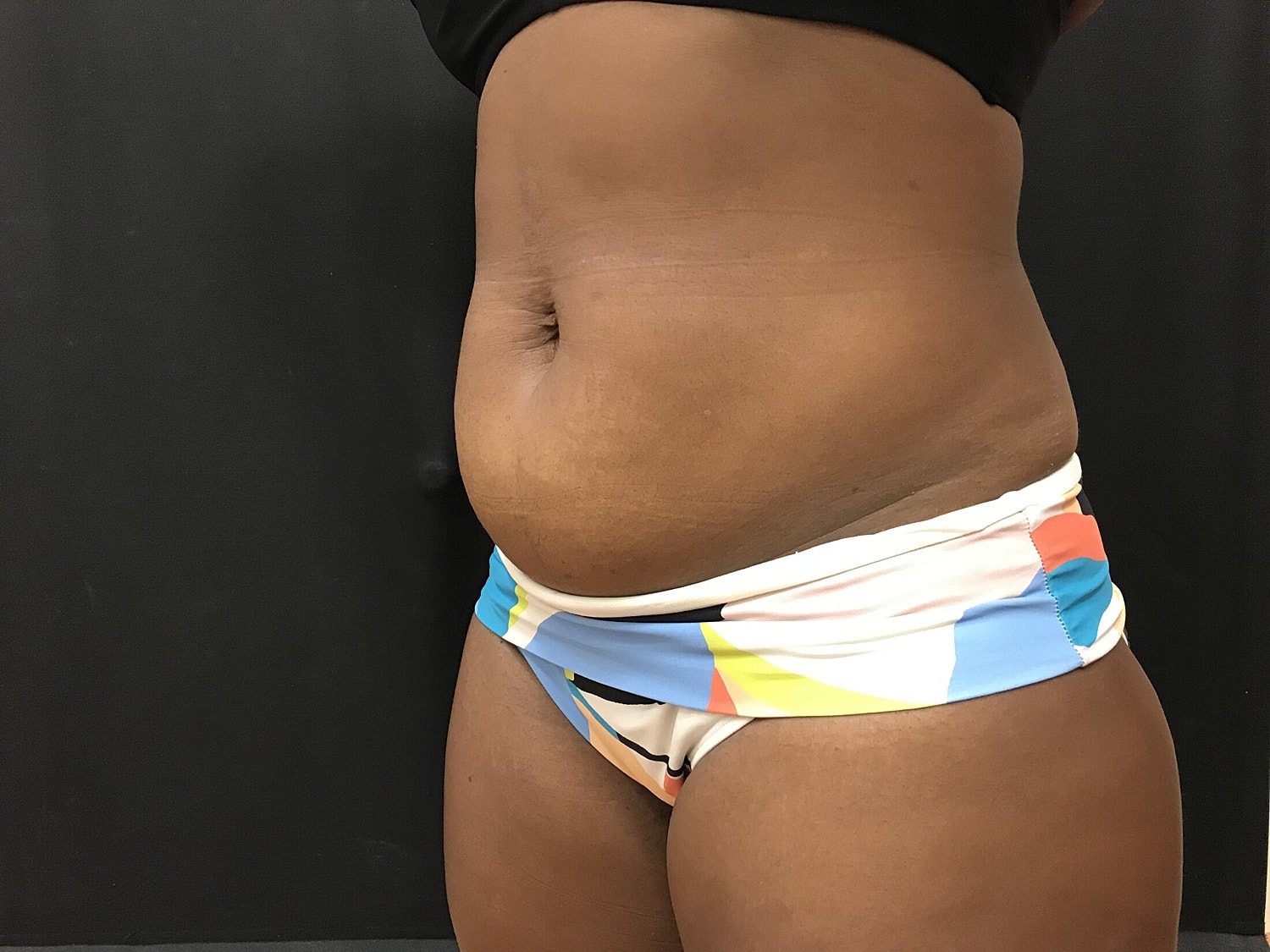 Tummy Tuck Before & After